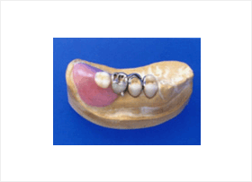 金属フレームと強化プラスチックの歯でできた部分入れ歯