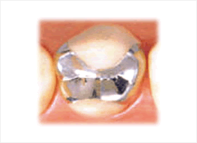 銀歯（パラインレー）イメージ