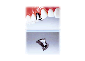 銀歯（パラクラウン）イメージ