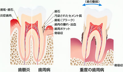 歯周病のメカニズム