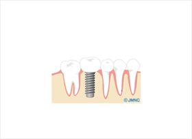 インプラント手術イメージ