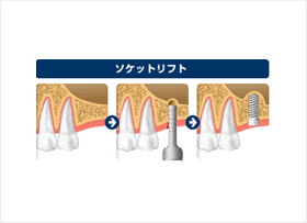 ソケットリフトイメージ